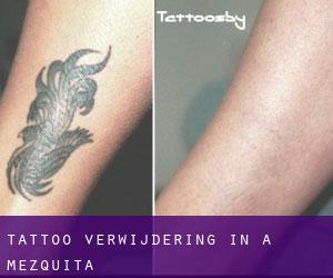 Tattoo verwijdering in A Mezquita