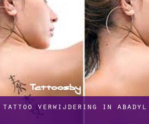Tattoo verwijdering in Abadyl