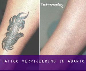 Tattoo verwijdering in Abanto