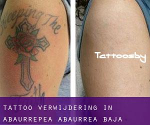 Tattoo verwijdering in Abaurrepea / Abaurrea Baja