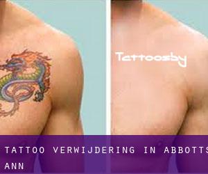 Tattoo verwijdering in Abbotts Ann
