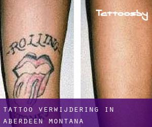 Tattoo verwijdering in Aberdeen (Montana)