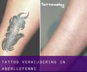 Tattoo verwijdering in Aberllefenni