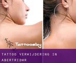 Tattoo verwijdering in Abertridwr