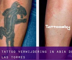 Tattoo verwijdering in Abia de las Torres