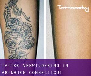 Tattoo verwijdering in Abington (Connecticut)