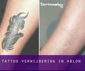 Tattoo verwijdering in Ablon