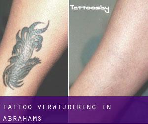 Tattoo verwijdering in Abrahams