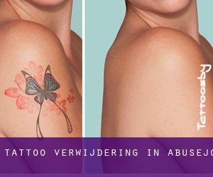 Tattoo verwijdering in Abusejo