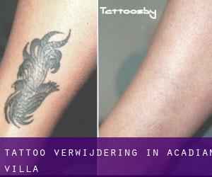Tattoo verwijdering in Acadian Villa