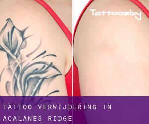 Tattoo verwijdering in Acalanes Ridge