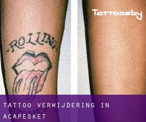 Tattoo verwijdering in Acapesket