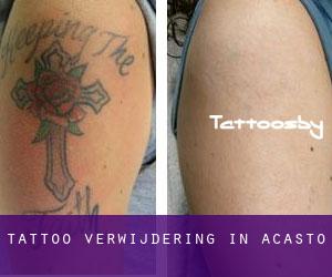 Tattoo verwijdering in Acasto
