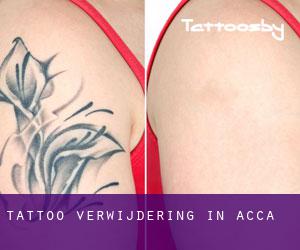 Tattoo verwijdering in Acca