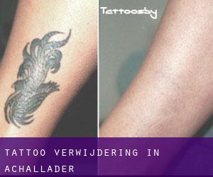 Tattoo verwijdering in Achallader