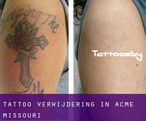 Tattoo verwijdering in Acme (Missouri)