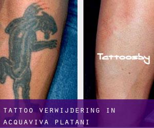 Tattoo verwijdering in Acquaviva Platani