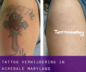 Tattoo verwijdering in Acredale (Maryland)