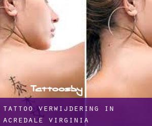 Tattoo verwijdering in Acredale (Virginia)