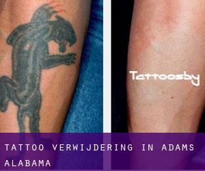 Tattoo verwijdering in Adams (Alabama)