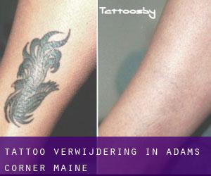 Tattoo verwijdering in Adams Corner (Maine)