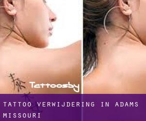 Tattoo verwijdering in Adams (Missouri)