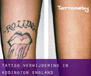 Tattoo verwijdering in Addington (England)