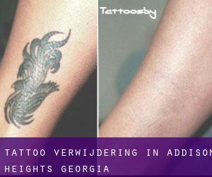 Tattoo verwijdering in Addison Heights (Georgia)