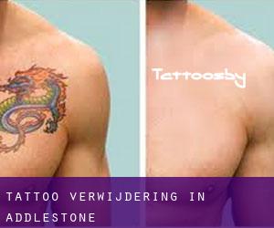 Tattoo verwijdering in Addlestone