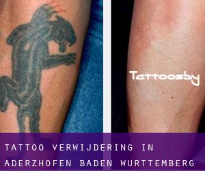 Tattoo verwijdering in Aderzhofen (Baden-Württemberg)