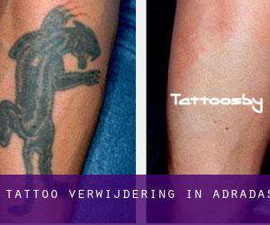 Tattoo verwijdering in Adradas
