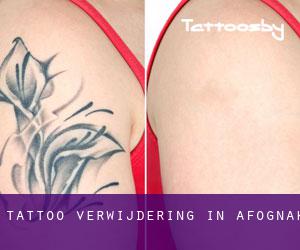 Tattoo verwijdering in Afognak
