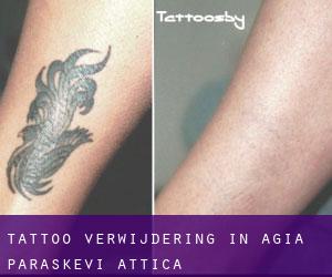 Tattoo verwijdering in Agía Paraskeví (Attica)