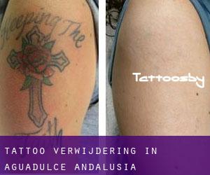 Tattoo verwijdering in Aguadulce (Andalusia)