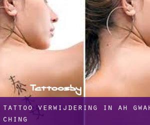 Tattoo verwijdering in Ah-gwah-ching