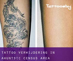 Tattoo verwijdering in Ahuntsic (census area)