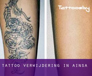 Tattoo verwijdering in Aínsa