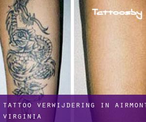 Tattoo verwijdering in Airmont (Virginia)