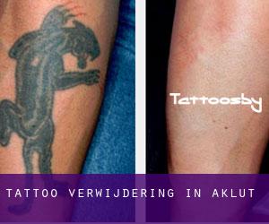 Tattoo verwijdering in Aklut