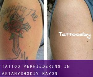 Tattoo verwijdering in Aktanyshskiy Rayon