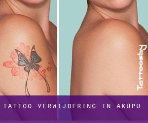 Tattoo verwijdering in Akupu