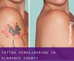 Tattoo verwijdering in Alamance County