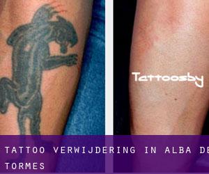 Tattoo verwijdering in Alba de Tormes
