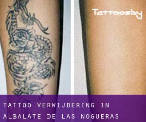 Tattoo verwijdering in Albalate de las Nogueras