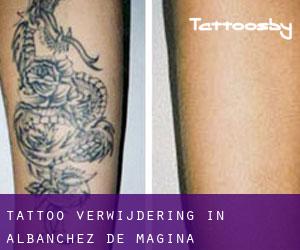 Tattoo verwijdering in Albanchez de Mágina