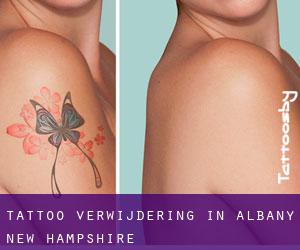 Tattoo verwijdering in Albany (New Hampshire)
