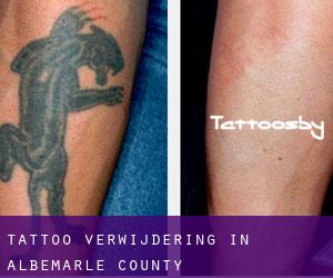 Tattoo verwijdering in Albemarle County
