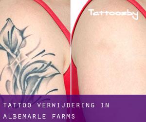 Tattoo verwijdering in Albemarle Farms