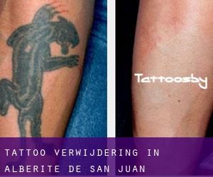Tattoo verwijdering in Alberite de San Juan