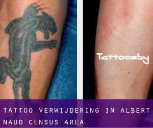 Tattoo verwijdering in Albert-Naud (census area)